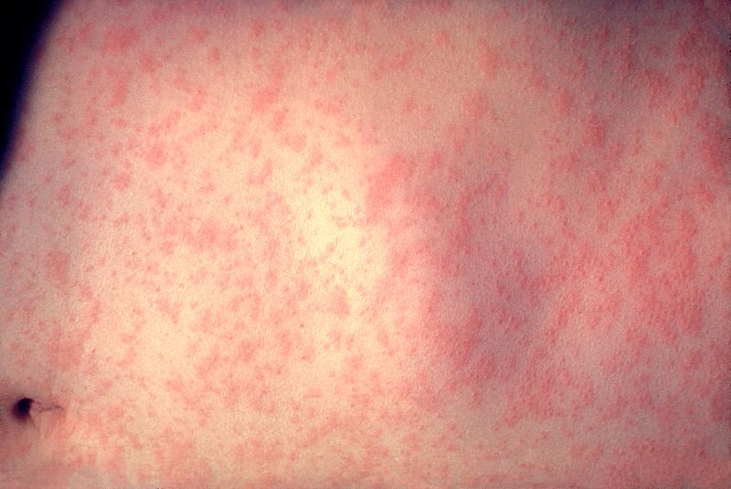 Anyone who believes they could have measles should self-quarantine, according to a statement from the Gritman Medical Center in Moscow.